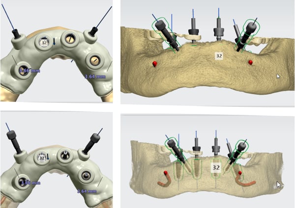 dental digital guided